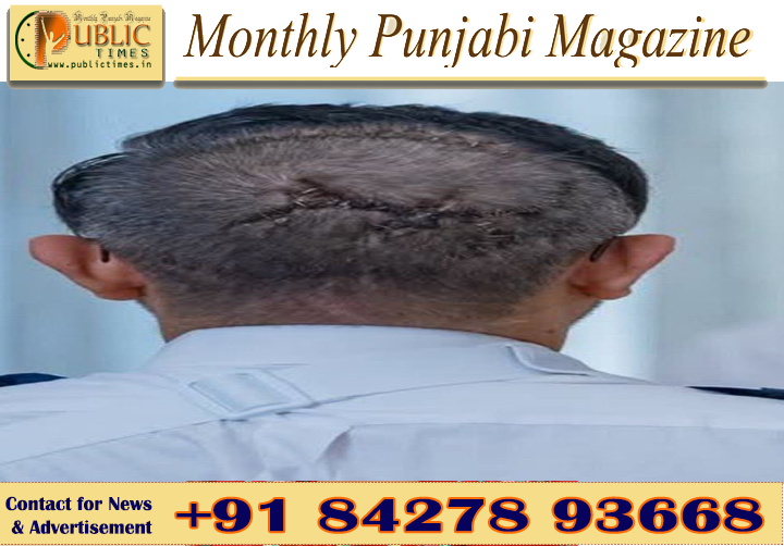 172 ਯਾਤਰੀਆਂ ਦੀ ਜਾਨ ਬਚਾਉਣ ਵਾਲੇ ਭਾਰਤੀ ਪਾਇਲਟ ਕੈਪਟਨ ਸਮਿਤ ਮੱਛਰ ਦੇ ਸਿਰ ’ਤੇ ਸਰਜਰੀ ਦੇ ਨਿਸ਼ਾਨ, ਸਾਹਮਣੇ ਆਈਆਂ ਨਵੀਆਂ ਤਸਵੀਰਾਂ